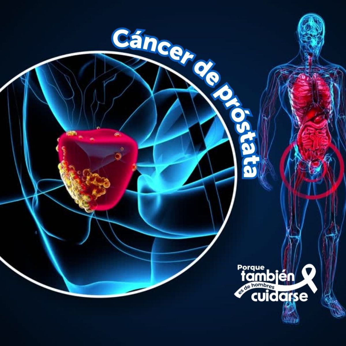 Cáncer de Próstata